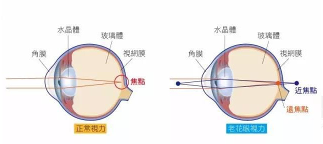 白內(nèi)障和老花眼區(qū)別，老花眼發(fā)病率正呈現(xiàn)年輕化趨勢