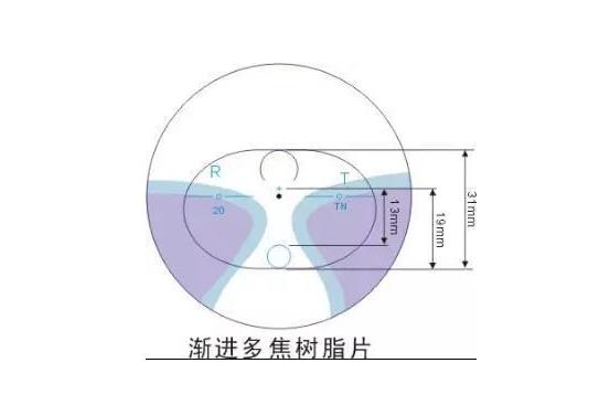 美麗島多焦鏡適合的人群，需要注意的事項(xiàng)