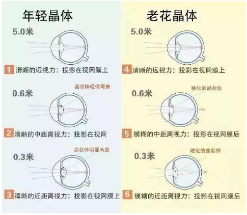 近視就不會老花了嗎？